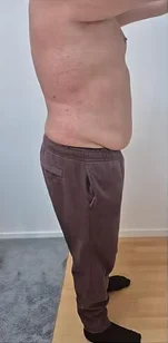 Nachher – Bauch – Seitenprofil